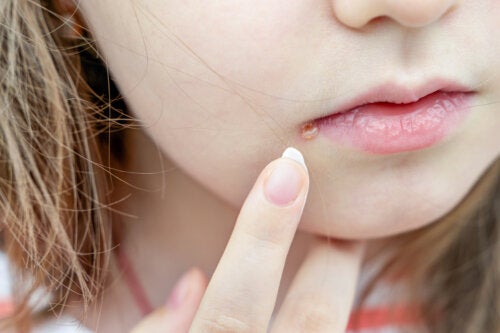 How to Tell The Difference Between a Pimple and a Cold Sore