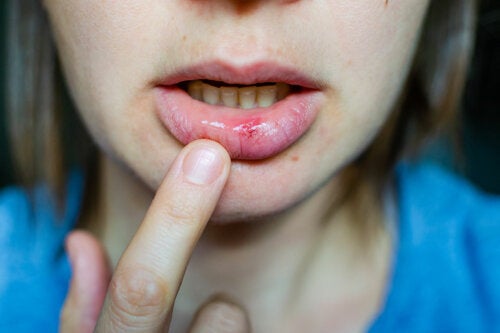 Home Remedies for Mouth Sores