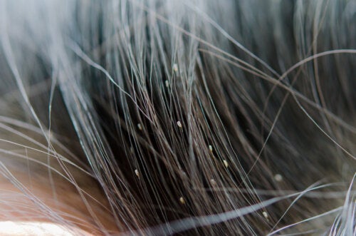 How to Identify Head Lice and Their Trails