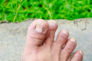 5 Types of Skin Fungus and How to Identify Them