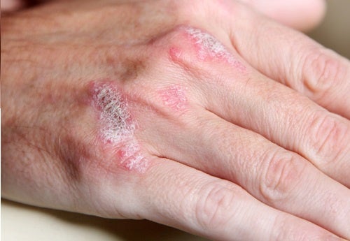 A Psoriasis Diet to Reduce Some Symptoms