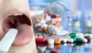 Treatment for Acute Tonsillitis