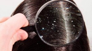 The Ultimate Dandruff Treatment to Forget About Dandruff for Good