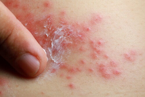 Can You Treat Psoriasis with Traditional Chinese Medicine?