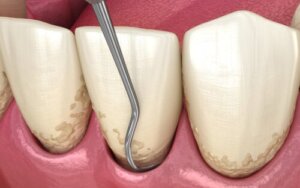 Dental Curettage: Procedure, Results and Care