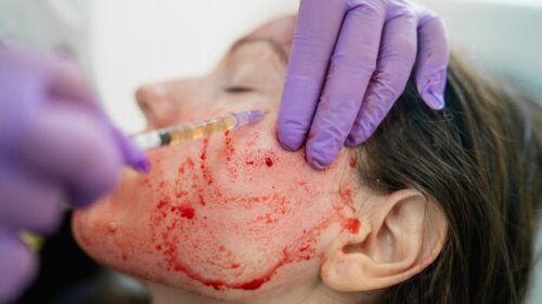 The Vampire Facial: What Is It and What Are The Risks?