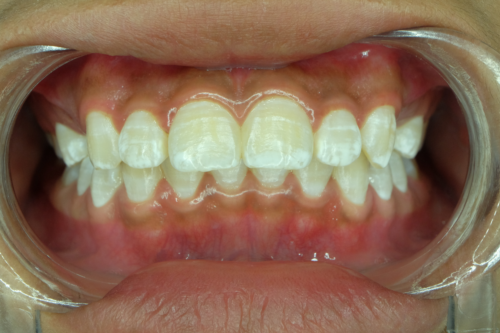 White Spots on the Teeth: Why Do They Appear?
