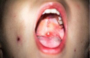 Gingivostomatitis in Children: What It Is and What to Do About It