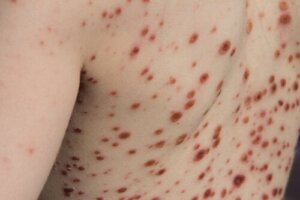 Monkeypox: Causes, Symptoms, Diagnosis and Treatment