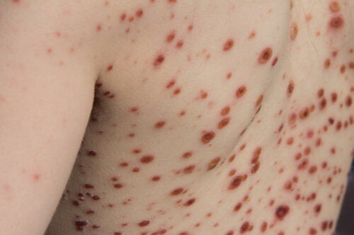 Monkeypox: Causes, Symptoms, Diagnosis and Treatment