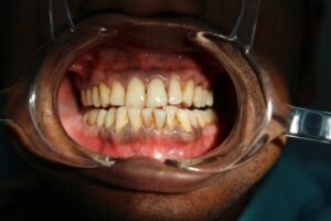 Black Spots on Your Gums: Causes and Treatments