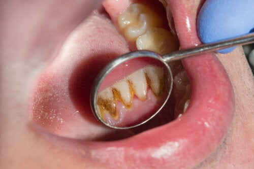 Why Does Tartar Turn Black? Treatment and Prevention