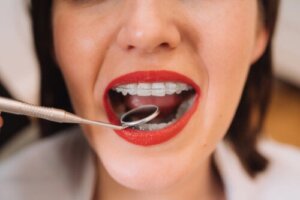 Ceramic and Sapphire Braces: The Advantages and Differences