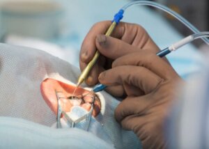 8 Side Effects of Cataract Surgery You Should Know About
