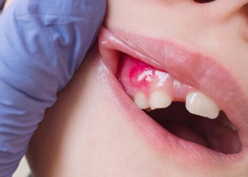 What Is a Dental Fistula and How Can It Be Treated?