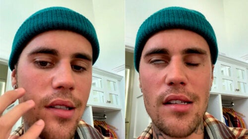 Justin Bieber's Ramsay Hunt Syndrome: What Is this Disease?