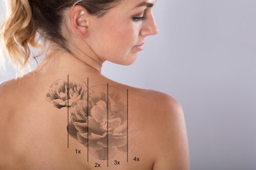 What Are the Risks of Laser Tattoo Removal?