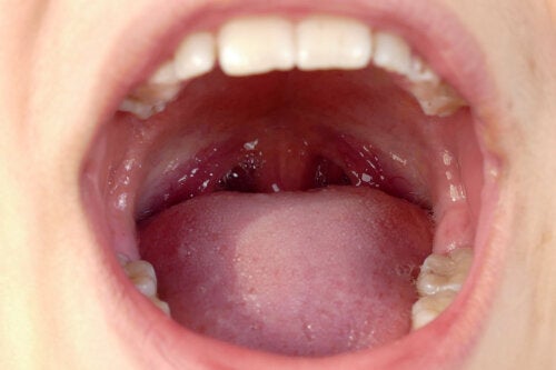 How to Prevent and Eliminate Tonsil Stones at Home