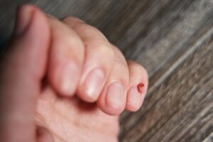 How to Recognize Nail Tumors
