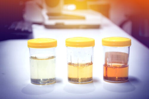 Dark or Cloudy Urine: 11 Possible Causes and Their Treatment