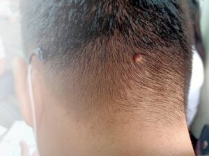 Warts on the Head: Causes, Risks and How to Remove Them