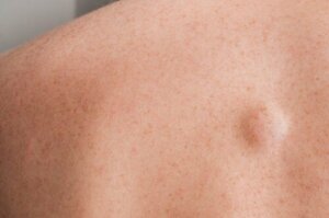 A Lump on the Back: 7 Possible Causes