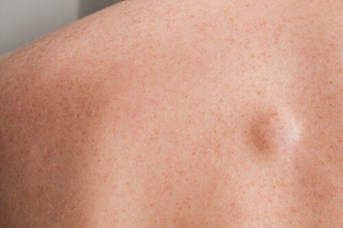 A Lump on the Back: 7 Possible Causes