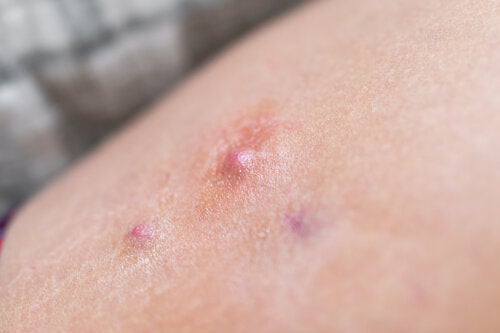 Why Is it Bad to Burst Hidradenitis Suppurativa Lumps?