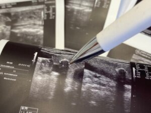 A Hypoechoic Nodule: What Is It and How to Identify One?