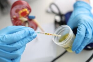 Urobilinogen in Urine: Causes and Normal Values