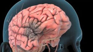 Cerebral Artery Thrombosis: What It Is, Causes, Symptoms and Treatment
