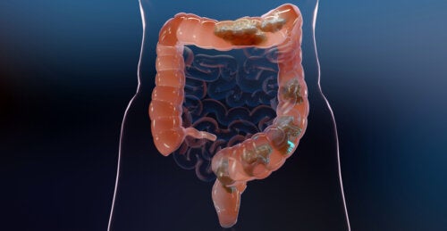 Colon Irrigation: Myths and Facts You Need to Know