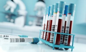 Total Protein Test Results and Their Significance