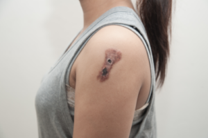 Squamous Cell Carcinoma: Causes, Symptoms, and Treatments