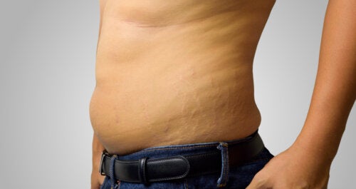 Stretch Marks in Men: Causes and How to Reduce Them Naturally