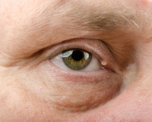 Hidrocystoma: What It Is, Causes and Treatment
