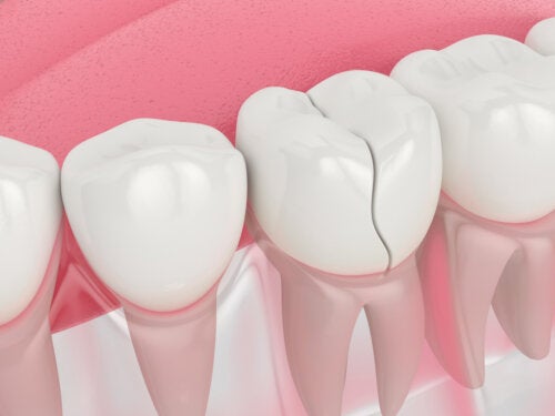 Dental Fissures: Causes and Treatment