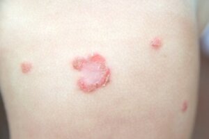 Impetigo in Children