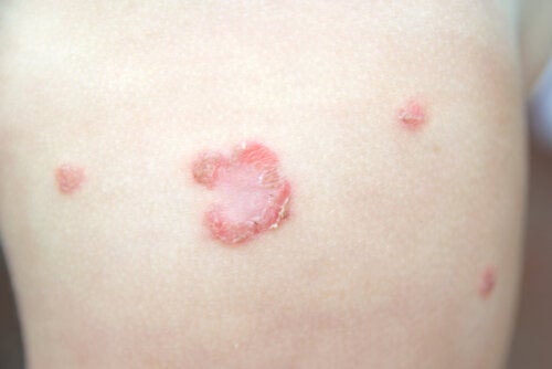 Impetigo in Children