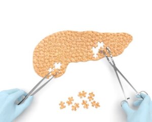 Pancreatic Cysts: Causes, Symptoms and Treatment