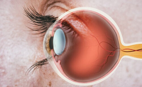 What Is Aphakia and How Is It Treated?