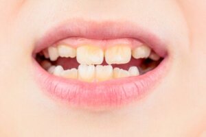 Amelogenesis Imperfecta: What Is It and How Is it Treated?