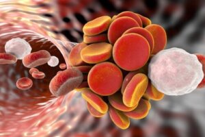 Antiphospholipid Syndrome: Causes, Symptoms, and Treatments
