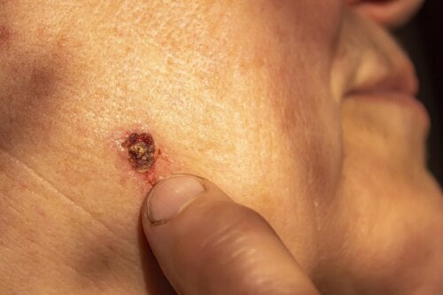 Basal Cell Carcinoma: The Most Common Skin Cancer