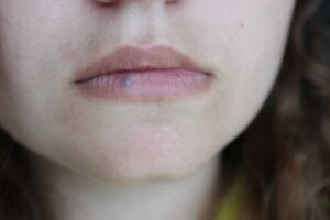 Lip Cancer: Causes, Symptoms and Treatment
