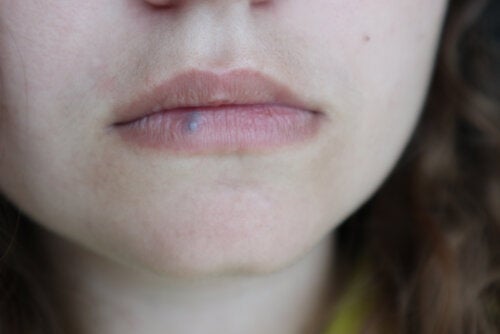 Lip cancer: causes, symptoms and treatments