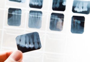 What is Dental Ankylosis and How Can it Be Treated?