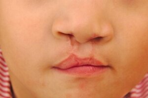 Dental Care for Children with a Cleft Palate