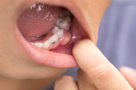 Symptoms of a Dental Infection that Has Spread to the Body