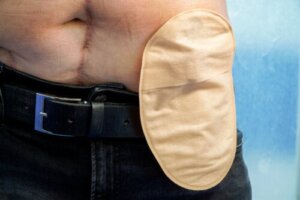 Tips for Day-to-Day Life After an Ostomy